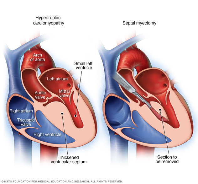 Septal myectomy