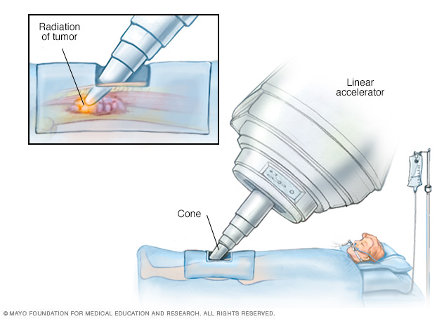 IORT for a thigh sarcoma